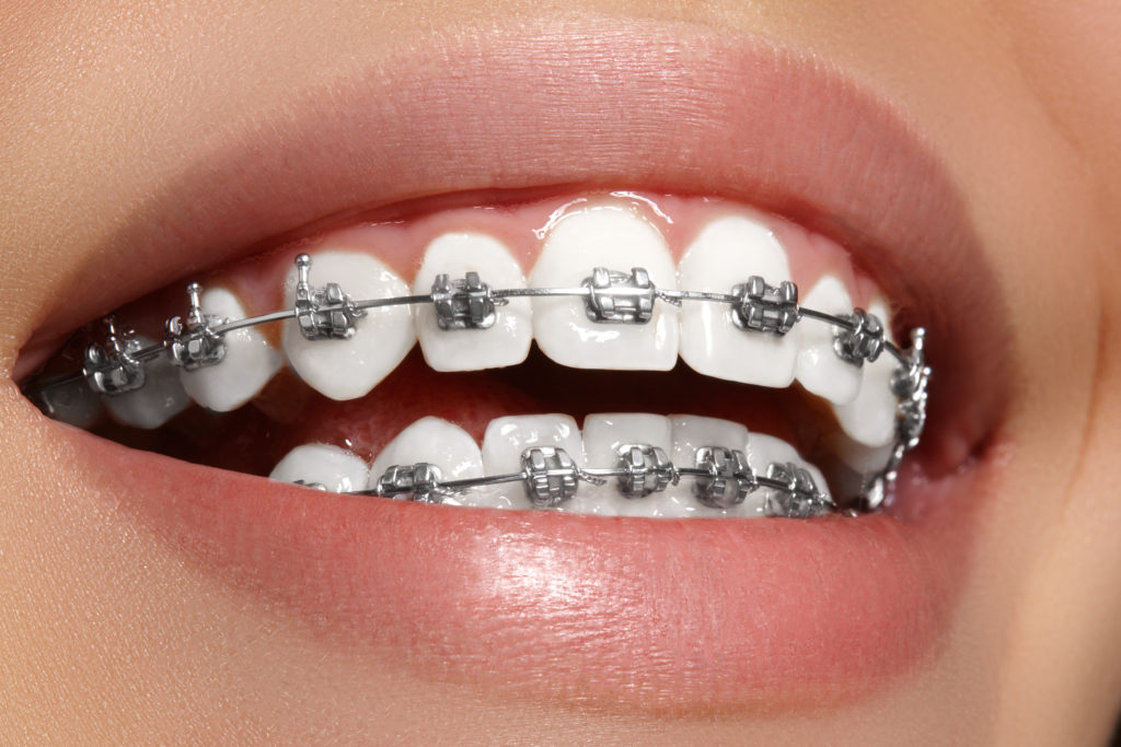 Advanced braces