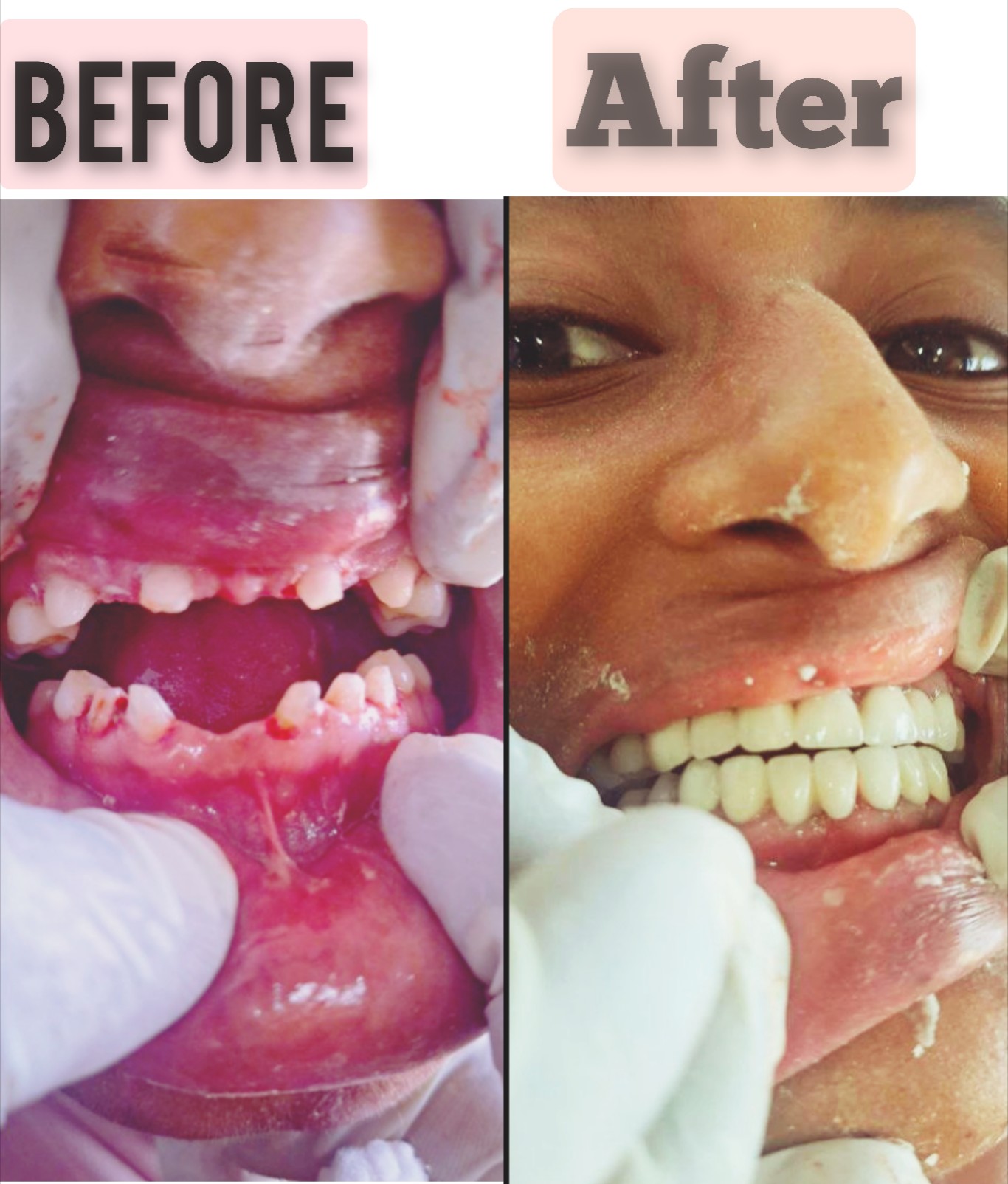 A patient's teeth before treatment.