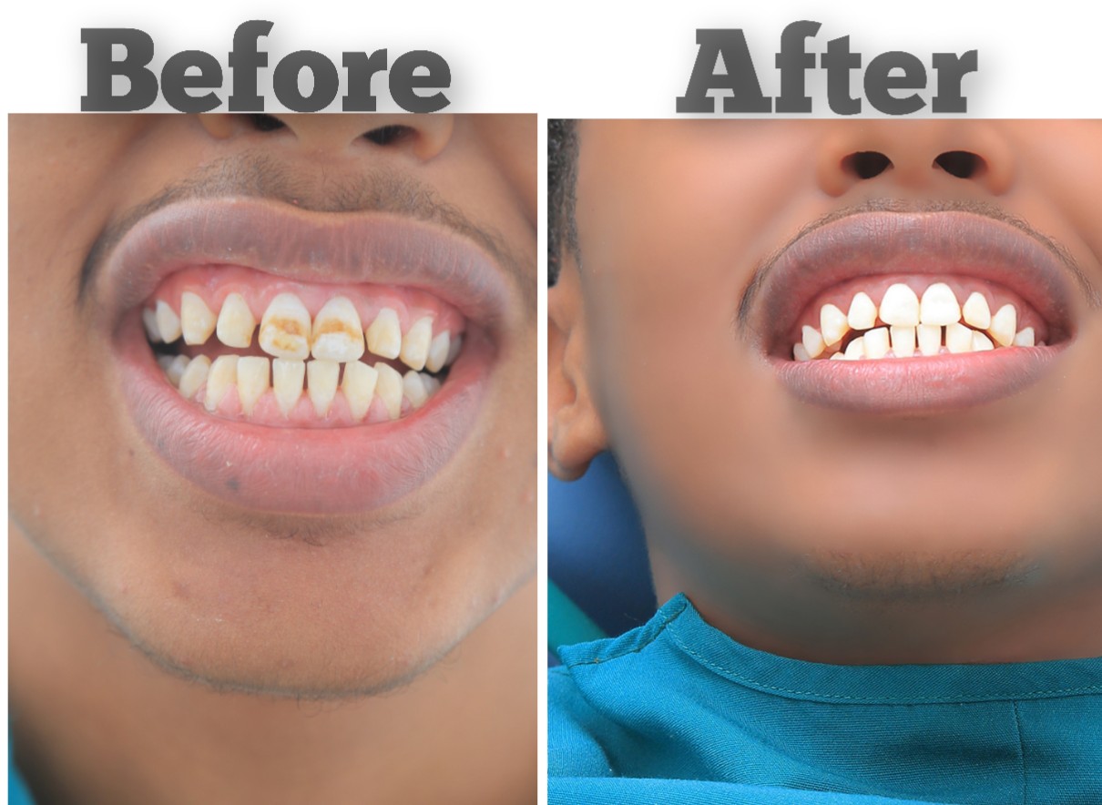 The patient's beautiful new smile after treatment.