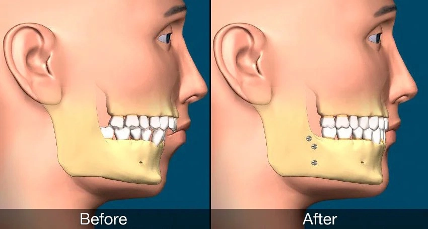 Jaw alignment