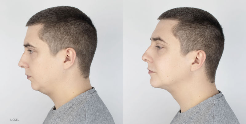 Jaw surgery