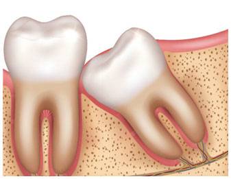 Wisdom tooth removal